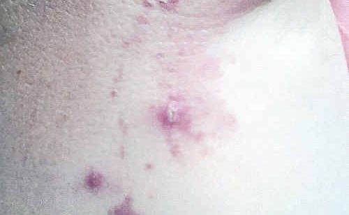A Warwick woman shows off her white tail spider bite which resulted from a stint in the garden. A Warwick woman shows off her white tail spider bite which resulted from a stint in the garden.